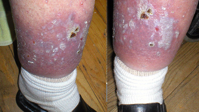 648x364-Stasis_Dermatitis_And_Ulcers.jpg