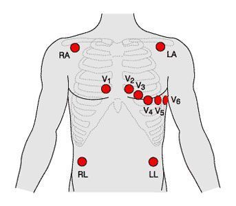 12-Lead-ECG-Placement.jpg