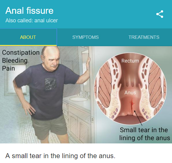 Anal Fissures.jpg