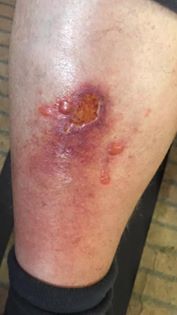 Hokes Blister Right Shin.jpg
