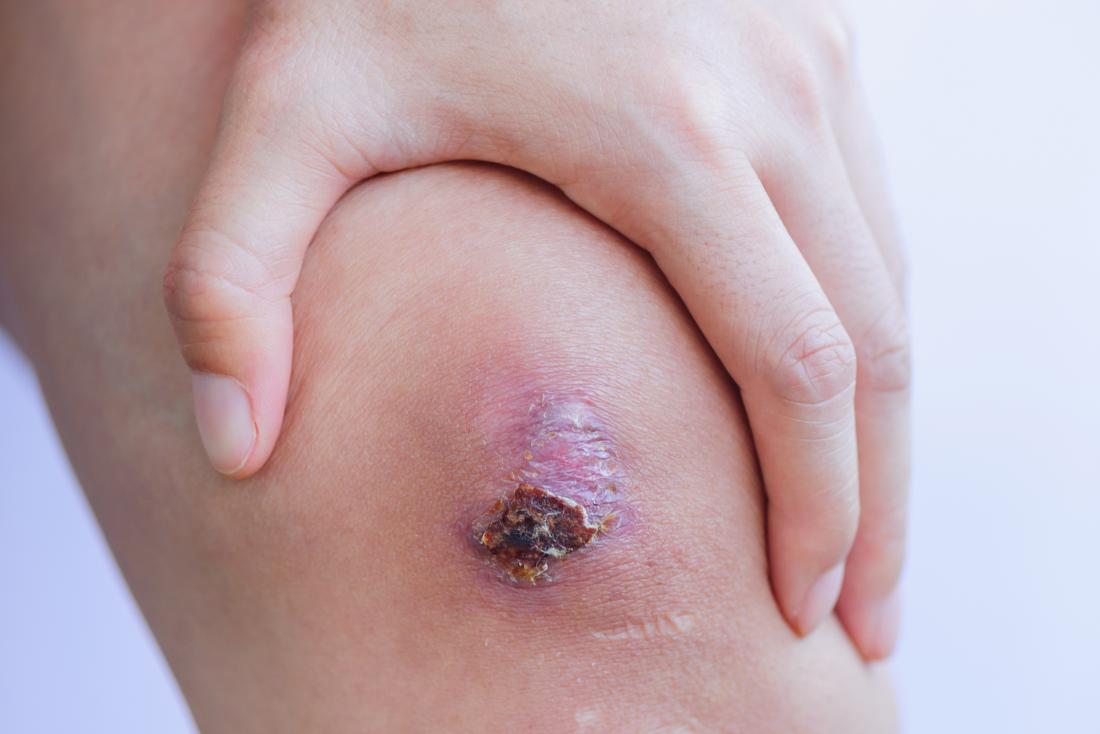 infected-scab-on-knee.jpg