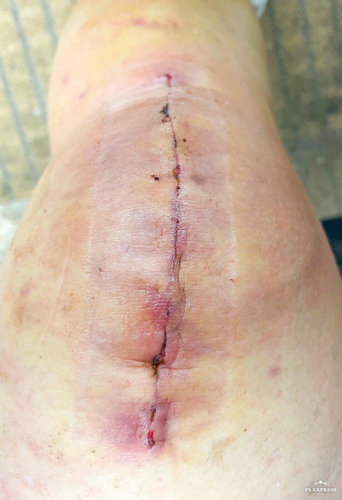 Knee LEFT after one week.jpg