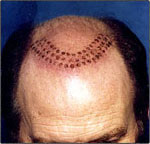 plugs_scalp.jpg