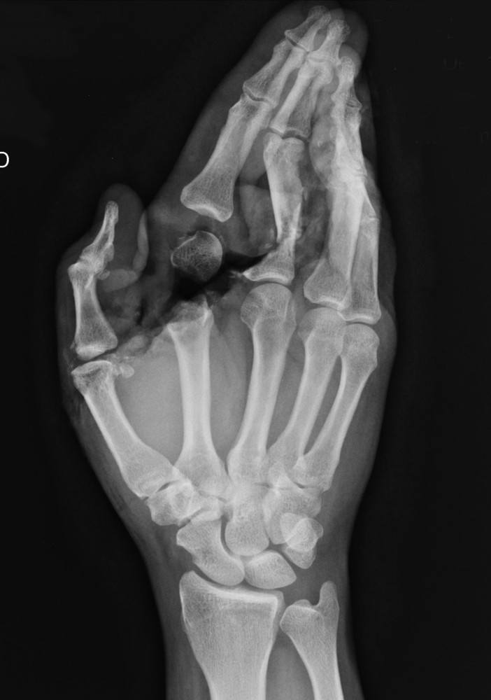 Rt Hand Xray.jpg