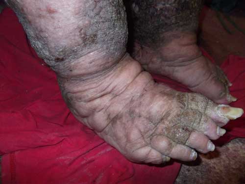 ugliest-feet-ever.jpg