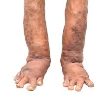 ugly feet.jpg
