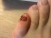 rotten toe of doom.jpg rotten toe of doom.jpg