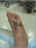 my foot post op.jpg