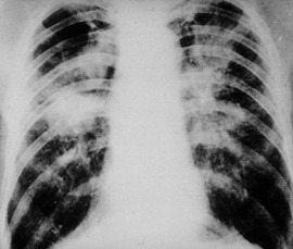 OWCP-Black-Lung-thumb.jpg