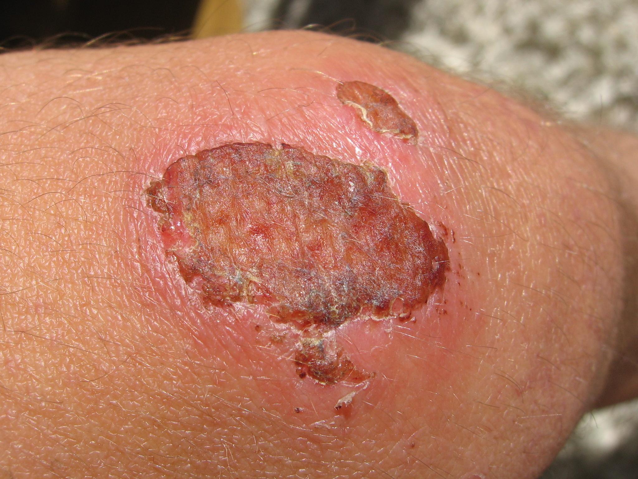 Scab.jpg