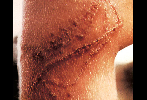 portuguese-man-of-war-sting.jpg