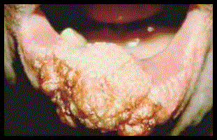 mouthcancer.gif